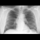 Bifid, forked rib: X-ray - Plain radiograph